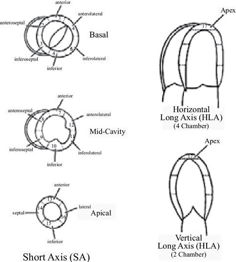 severe apical wall hypokinesis